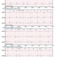 thumb: Cardiomatics Report Beispiel 6