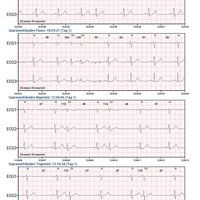 thumb: Cardiomatics Report Beispiel 6