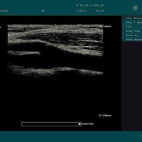 thumb: Karotide