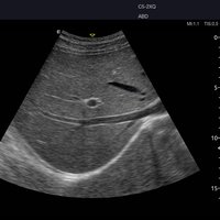 thumb: Abdominalscan mit dem Acclarix AX8 ohne eSRI