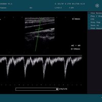 thumb: Karotide, doppler