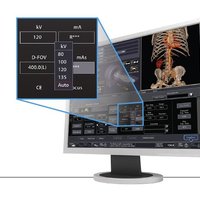 thumb: Anwendung der automatischen kV Selektion mit dem Aquilion Lightning SP